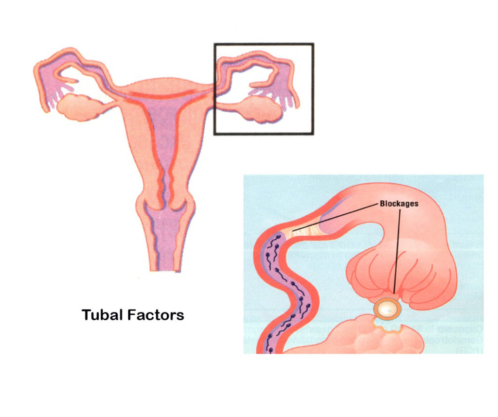 tubal factor of infertility