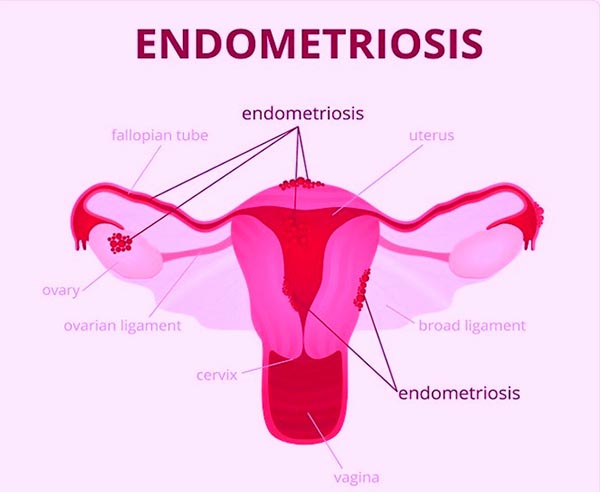 Laparoscopic surgeries for endometriosis yashadaa hospital